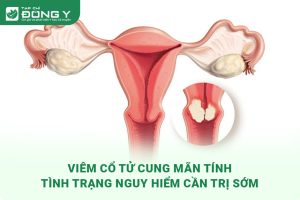 image-benh-viem-co-tu-cung-man-tinh-1-300x200-1 viem co tu cung man tinh