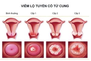 viem-lo-tuyen-co-tu-cung-la-van-de-cua-khong-it-chi-em-1-300x200-1